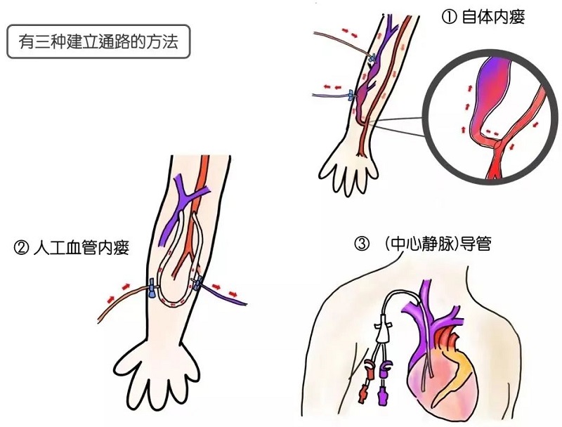 血管通路多学科诊疗模式，守护血透患者“生命线”