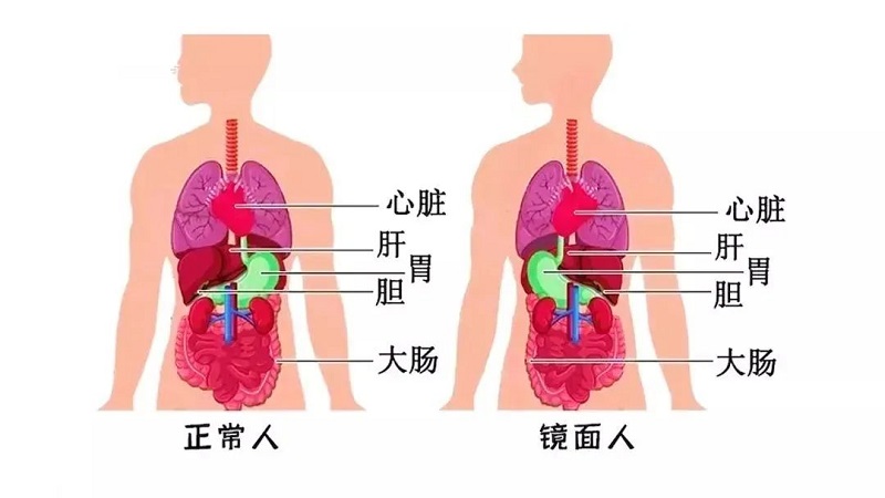 百万分之一罕见“镜面人”！五脏六腑反着长，手术也得反着来！