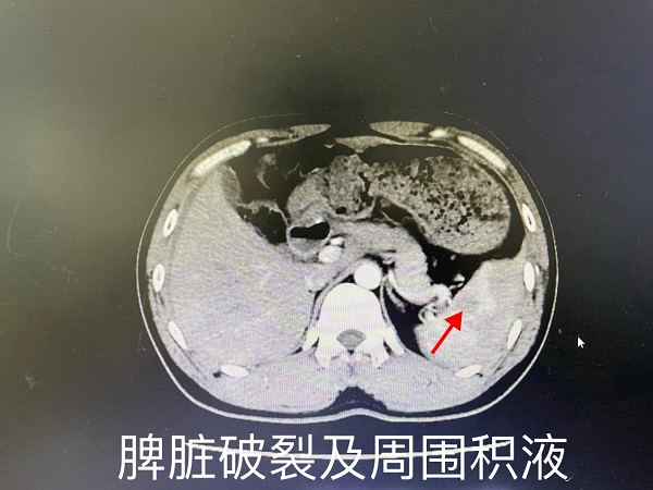 万载县首例——我院肝胆外科成功自主实施一例高难度全腹腔镜下全脾切除术